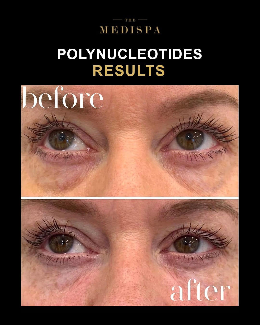 Polynucleotides before and after eye area results graphic for The Medispa