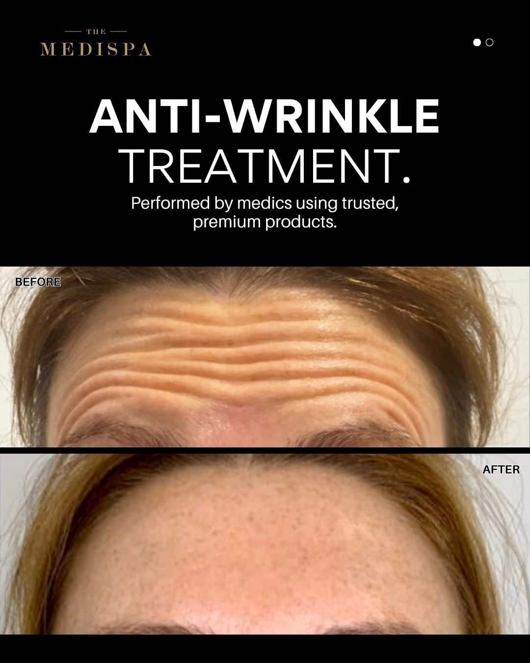 Anti-wrinkle forehead treatment before and after social graphic