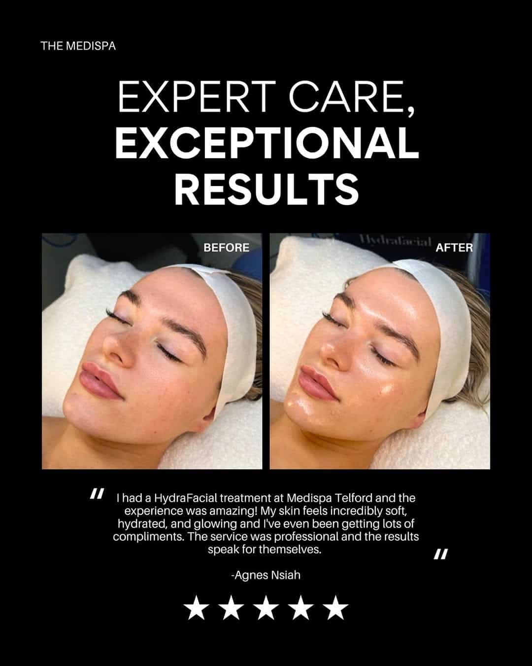 HydraFacial before and after graphic with a five star patient testimonial